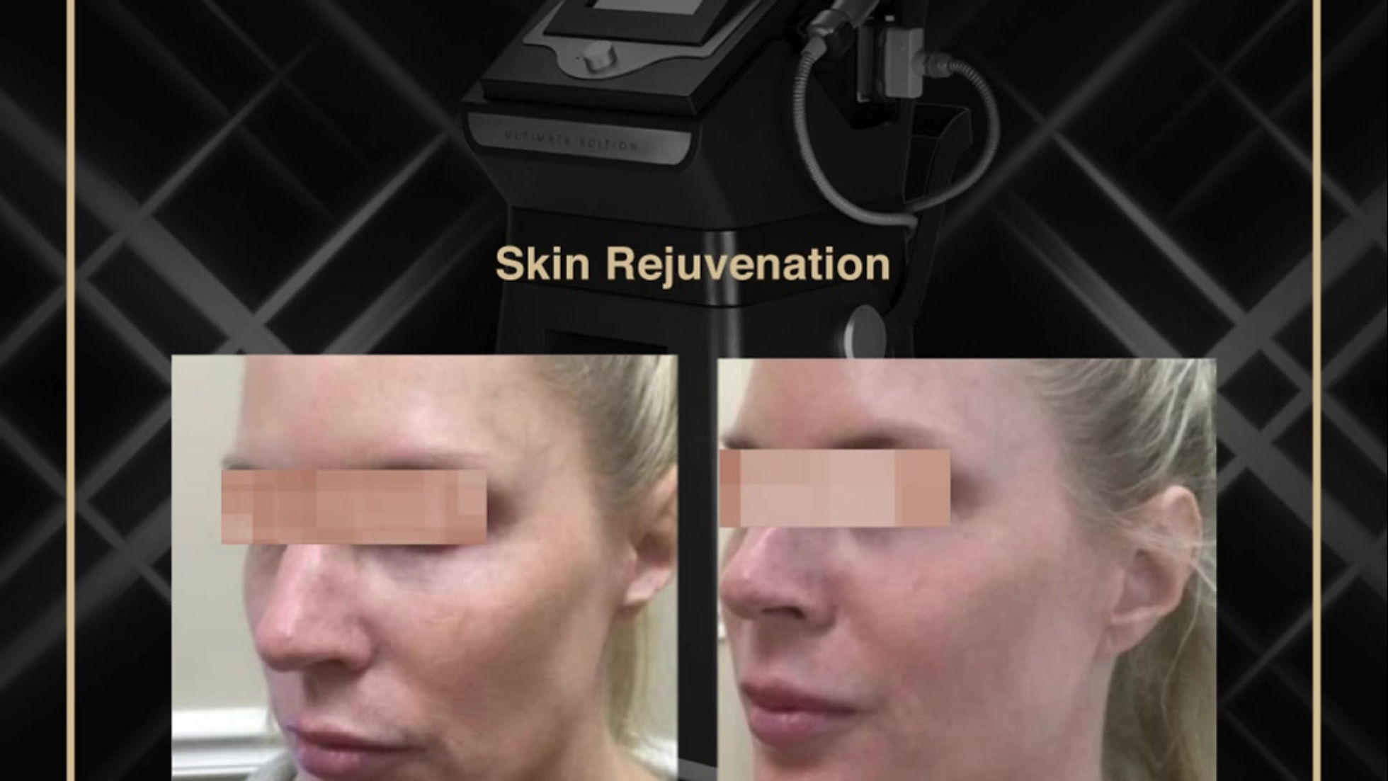 Sylfirm X : Skin Rejuvenation Before and After